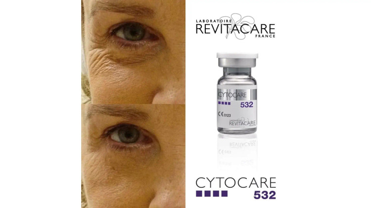 کوکتل مزوتراپی جوانساز رویتاکر Cytocare 532 اصل فرانسه